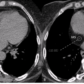 Non-contrast Axial Chest CT. Interatrial septum (IAS) thickened (A) with low density (B)
