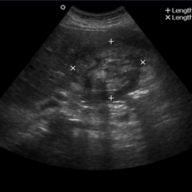 Ultrasound image showing hetero-echoic mass lesion in gall bladder fossa