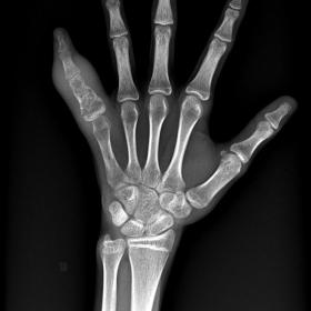 AP radiograph of left hand showing lytic expansile lesion involving proximal phalanx of left hand little finger