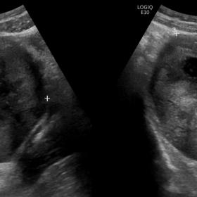 A. Heterogeneous adnexal mass with cystic central areas. Transverse and longitudinal planes