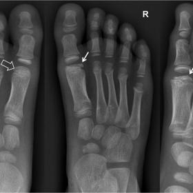Plain radiographs. AP view (middle) and oblique (right) of the right forefoot showing the flattening and sclerosis of the 1st