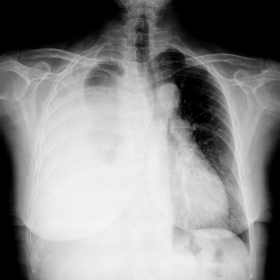 Initial PA chest radiography. Nearly complete white-out of the right hemithorax with contralateral mediastinal shift can be o