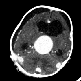 Axial, coronal and sagittal images demonstrate the aneurysmally dilated midline venous pouch representing dil