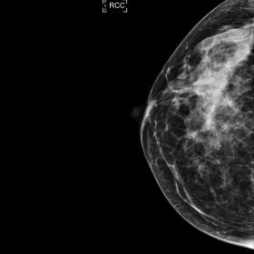 Right breast mammography, CC view