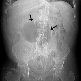 CT topogram reveals an abnormally positioned and distended cecum (arrows). There is no dilatation of the remaining large bowe