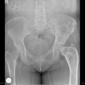 Plain X-ray of pelvis (AP view). Heterogeneous, expansile radiolucent mass at left iliac bone and proximal femur. Notice there is no periosteal reaction and no breaching or destruction of the cortical of bone