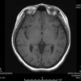 Axial cranial T1 MR; The pathological  signal at the left globus pallidus   level can be difficulty selected in T1 image