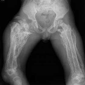 Plain radiography of the pelvis and lower extremities showing shortening of the diaphysis of the right femur, calcification o