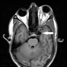 Axial T1-weighted(a) and T2- weighted (b and c) images of brain demonstrate an enlarged left cavernous sinus with multiple fl