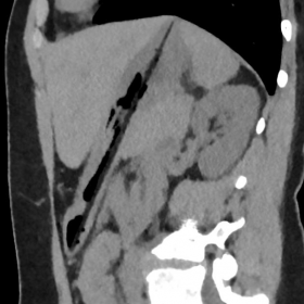 This sagittal view with abdominal window setting 30/350 shows a linear hypodensity present in the stomach. Air was projecte