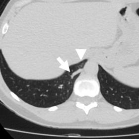 Chest CT reveals a vascular structure coursing the posterior segment of the right lower lobe (arrow), associated with subtle 