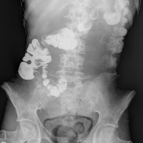Radiograph shows curvilinear areas of increased radiolucency in the region of the urinary bladder wall