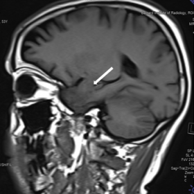 MR imaging of brain T1 weighted sagittal section shows hypointensities in the bilateral temporal region