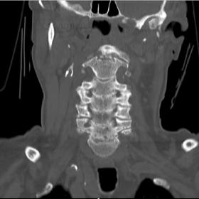 Coronal view of Cervical Spine showing Odonotid peg fracture