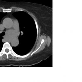 A well-defined markedly enhancing mass with few non-enhancing necrotic/cystic areas is noted in the left paratracheal area, l