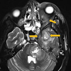T2 hypointense lesion in the intraconal & extraconal space of left orbit with left cavernous sinus thickening