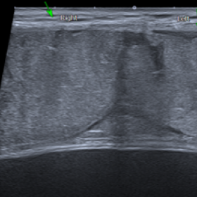 US scan of the rectus abdominis muscle demonstrating diffuse thickening, hypoechogenicity and loss of normal fascicular muscl