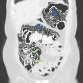 Coronal image of CT (lung window) shows gas-filled cysts on the subserosa (blue arrows) and submucosa (green arrows) of the c