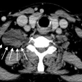 Axial contrast-enhanced CT image shows a right paraspinal lesion (white arrows) predominantly hypodense, that contacts the an