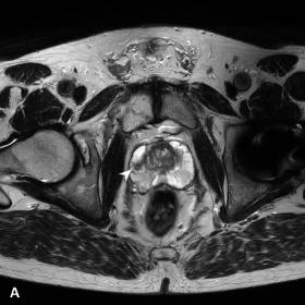 Axial (A) and coronal (B) T2-weighted MRI showing a nodular hypointense lesion in the right lateral peripheral zone (arrowhea