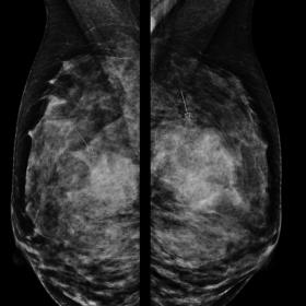 MLO (a) and CC mammograms (b) show two high-density irregular masses with indistinct margins in the upper-inner quadrant of t