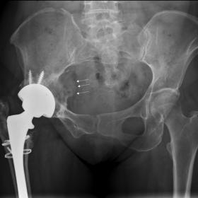 Frontal pelvic radiograph shows right THR with cortical irregularity and sclerosis of right iliac bone related to the acetabu