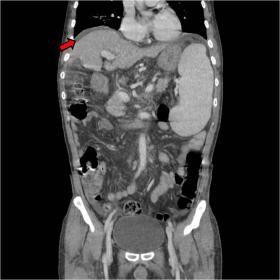 Coronal image of abdominal contrast enhanced CT shows heterogeneity and atrophy of the liver parenchyma, splenomegaly and asc