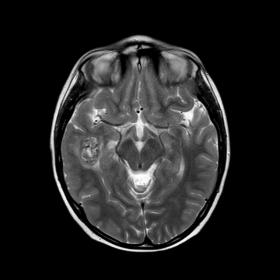 T2 W axial image. There is a hemorrhagic mass, approximately 2 cm diameter at right temporal lobe