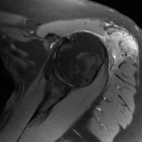 Axial PD FS (a) and coronal T2 FS(b) demonstrate the ill defined heterogeneously bright intramuscular lesion in the deltoid w