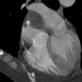 Coronal portal venous phase contrast study showing a homogenous fat density lesion in the interatrial septum