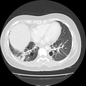 Axial CT shows several cystic lung bilateral lesions. Associated tenuous ground glass opacities converging at lower segments 
