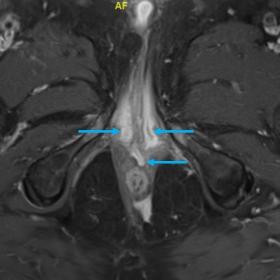 Enhancing fistulous tract extending anterior from upper anal canal, bifurcating and reconnecting within posterior scrotum (bl