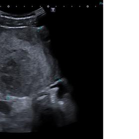 Ultrasound examination showed a heterogeneous solid mass in the hepatic hilum.