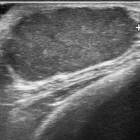 Ultrasonography reveals a slightly indistinct, microlobulated, and hypoechoic tumor on the right retro areolar area.