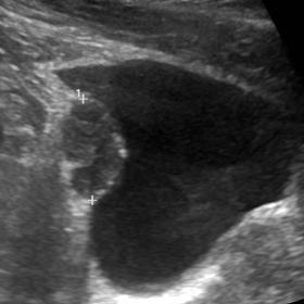 Sagittal US image of the urinary bladder shows a heterogeneous mass at right posterior-lateral bladder wall, near the base (a