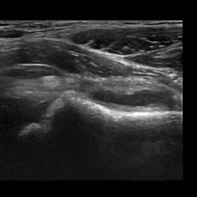 Ultrasound image of the left femoral head and neck. A joint effusion of 8 mm can be seen anterior to the femoral neck