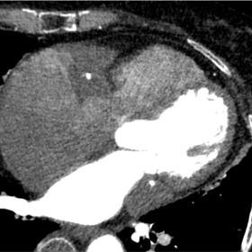 Axial ECG-gated CT. Extensive pseudotumor lesions along RCA and LCx
