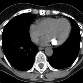 Axial non-enhanced (a) and contrast-enhanced (b) chest CT at the level of the mass