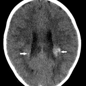 Cranial CT axial images from bottom to top revealed extensive bilateral calcifications in bilateral parieto-occipital white m