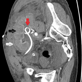 Oblicuous CECT of a right lower quadrant transplant kidney shows diffuse cortical hypoenhancement (red arrow) with preserved 