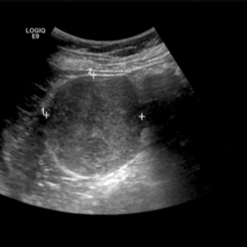 Right ovary ultrasound showing no evidence of calcification, no posterior acoustic enhancement and heterogenous echogenicity