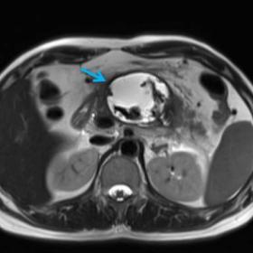 Axial T2 weighted turbo spin echo image shows a 5x6cm cystic area with well-formed hypointense margins and internal T2 hypoin