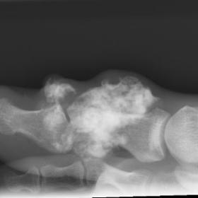 X-ray of the right big toe demonstrated several mineralised densities with calcification in the interphalangeal joint