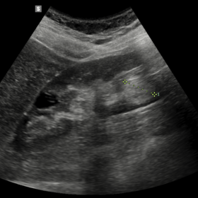 Routine US revealed a 2 cm, hyperechoic lesion of the lower third of the right kidney located in the renal sinus