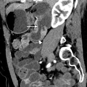 Sagittal contrast-enhanced CT enterography shows the orifice (arrow) as well as the blind-ending sac of the intraluminal duod