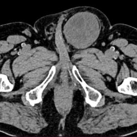 NCCT abdomen pelvis axial section in soft tissue window shows a well defined soft tissue density lesion in left inguinal regi