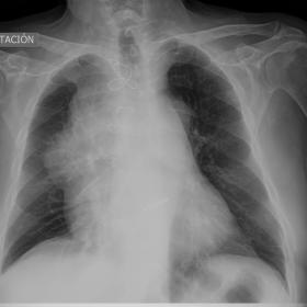 Chest radiograph – AP projection: widening of the upper mediastinum with lateral displacement of the paracaval line and con