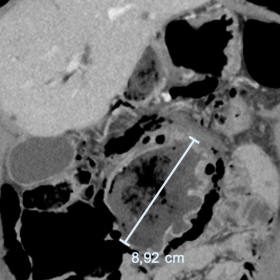 CT-abdomen with intravenous contrast in portal venous phase, shows a giant duodenal diverticulum with thickened duodenal wall