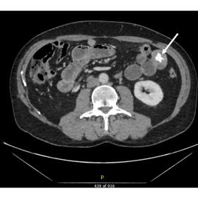 CT scan (axial view) demonstrating an area of intraluminal calcification within the proximal jejunum representing an enteroli