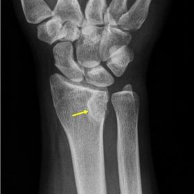 A well-defined osteolytic lesion in the distal radius with intact surrounding soft tissues (arrow)